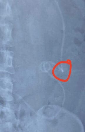 When there’s a “kink” in the armour….